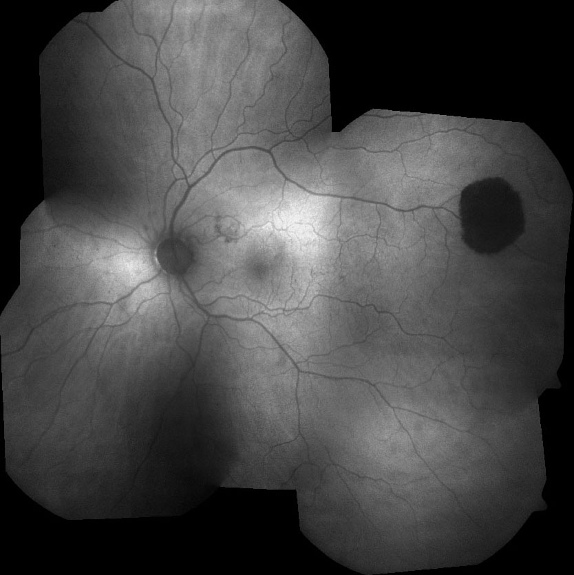 Figure 9.7.3 Congenital Hypertrophy of the Retinal Pigment Epithelium (“CHRPE”)