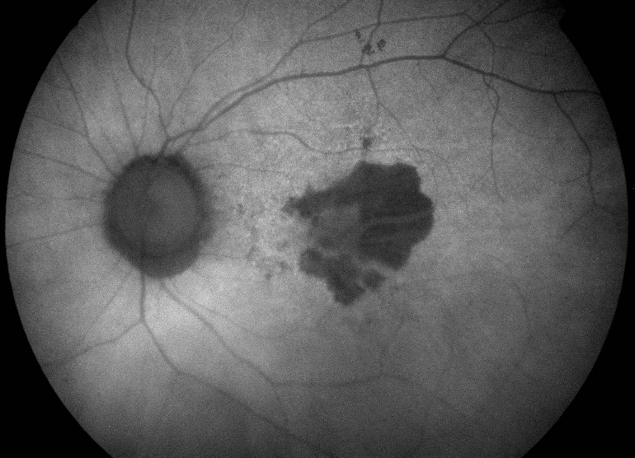 Figure 9.7.4 Geographic Atrophy