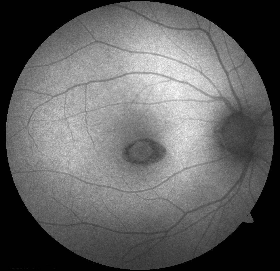 Figure 9.7.5 Hydroxychloroquine Maculopathy