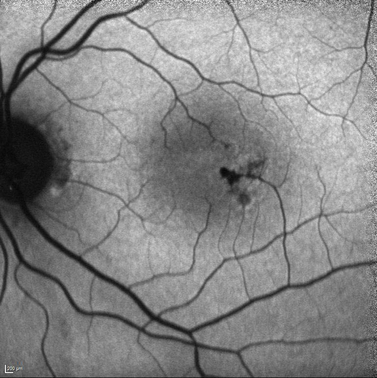 Figure 9.7.6 Macular Telangiectasia (Mactel) Type 2