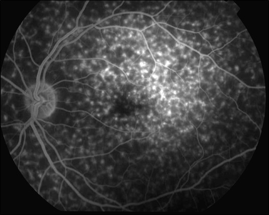 Figure 9.8.10 Fundus Flavimaculatus (ABCA4 Gene Mutation)