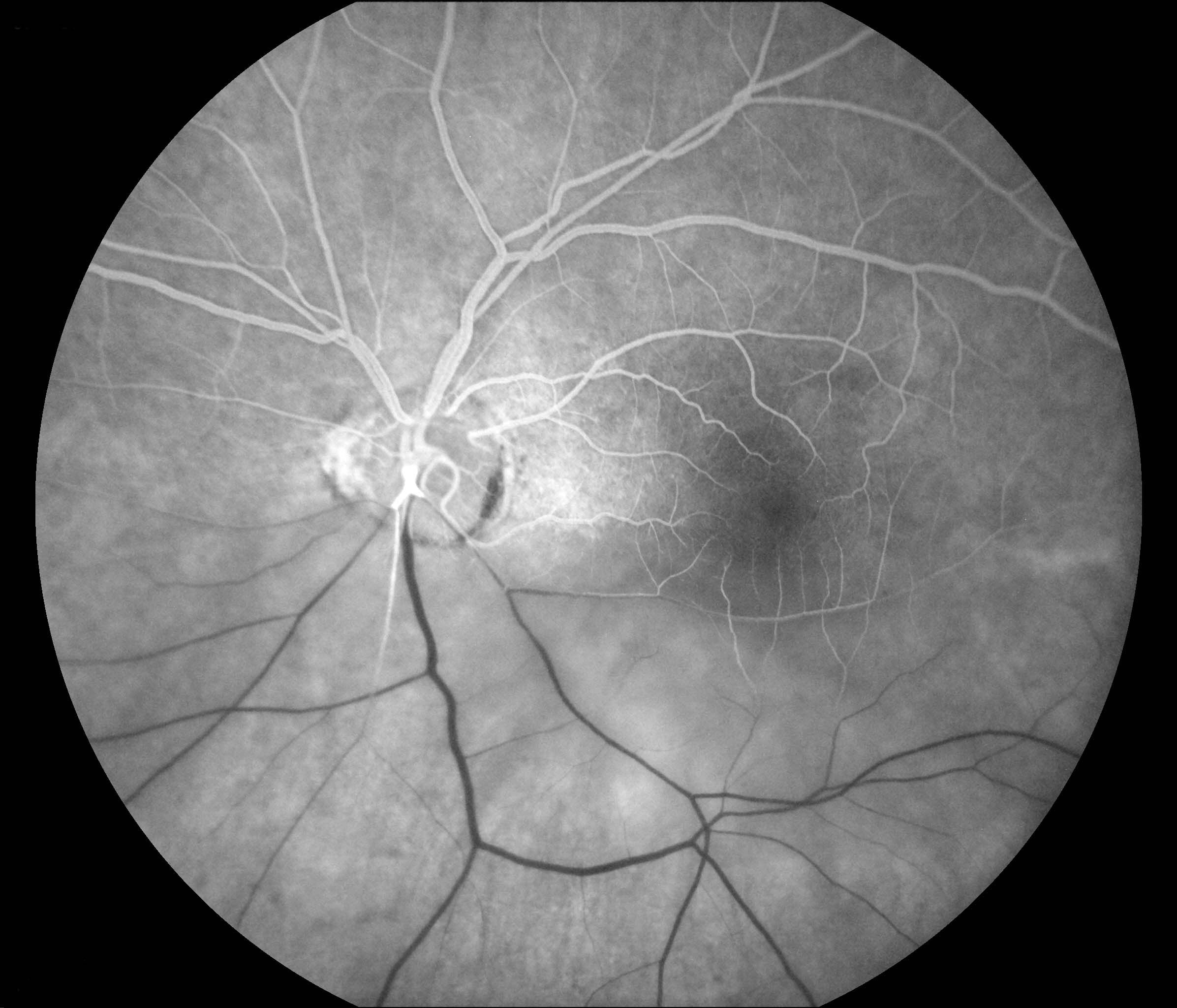 Figure 9.8.11 Hemi-retinal Artery Occlusion