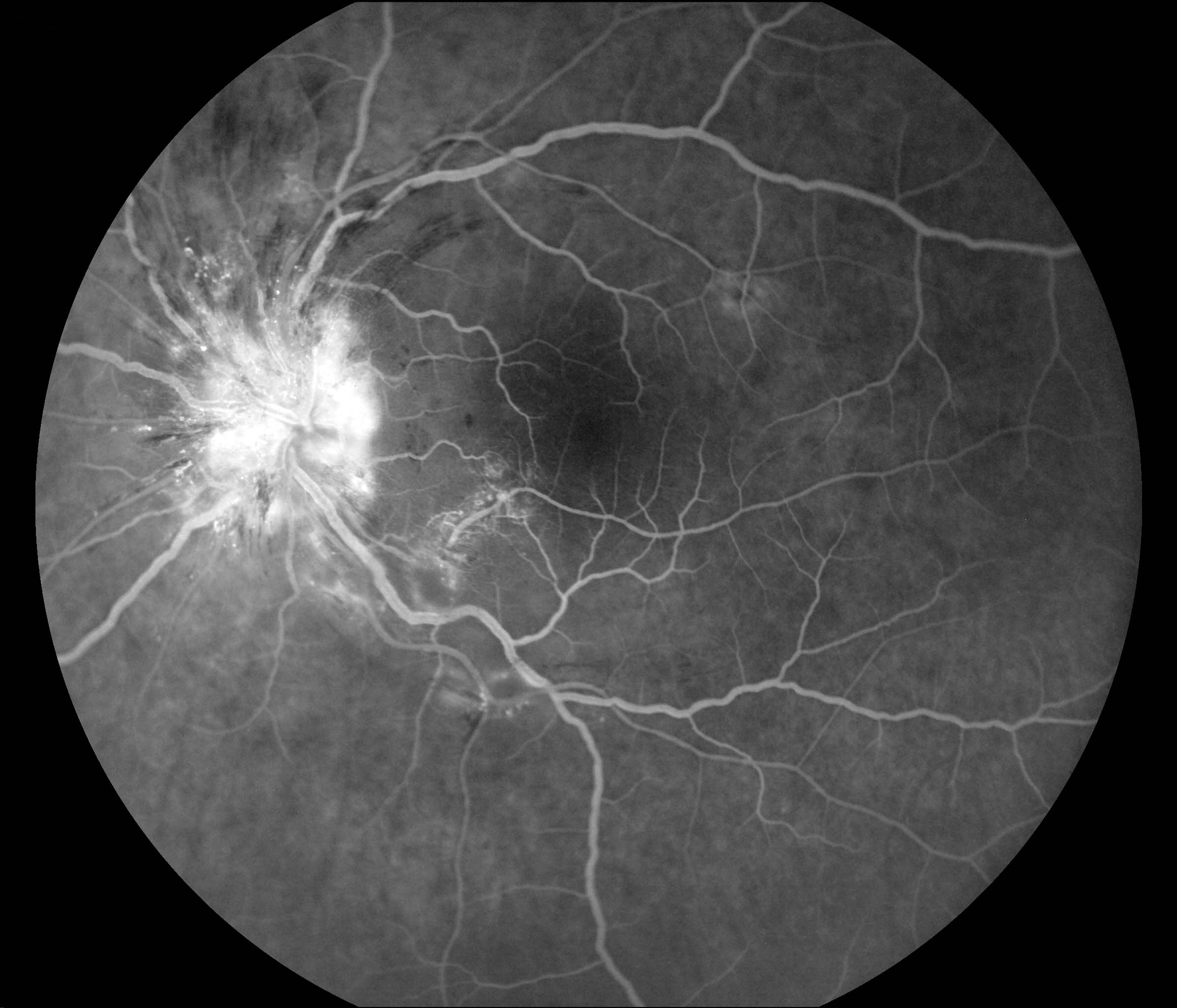 Figure 9.8.12 Hypertensive Retinopathy