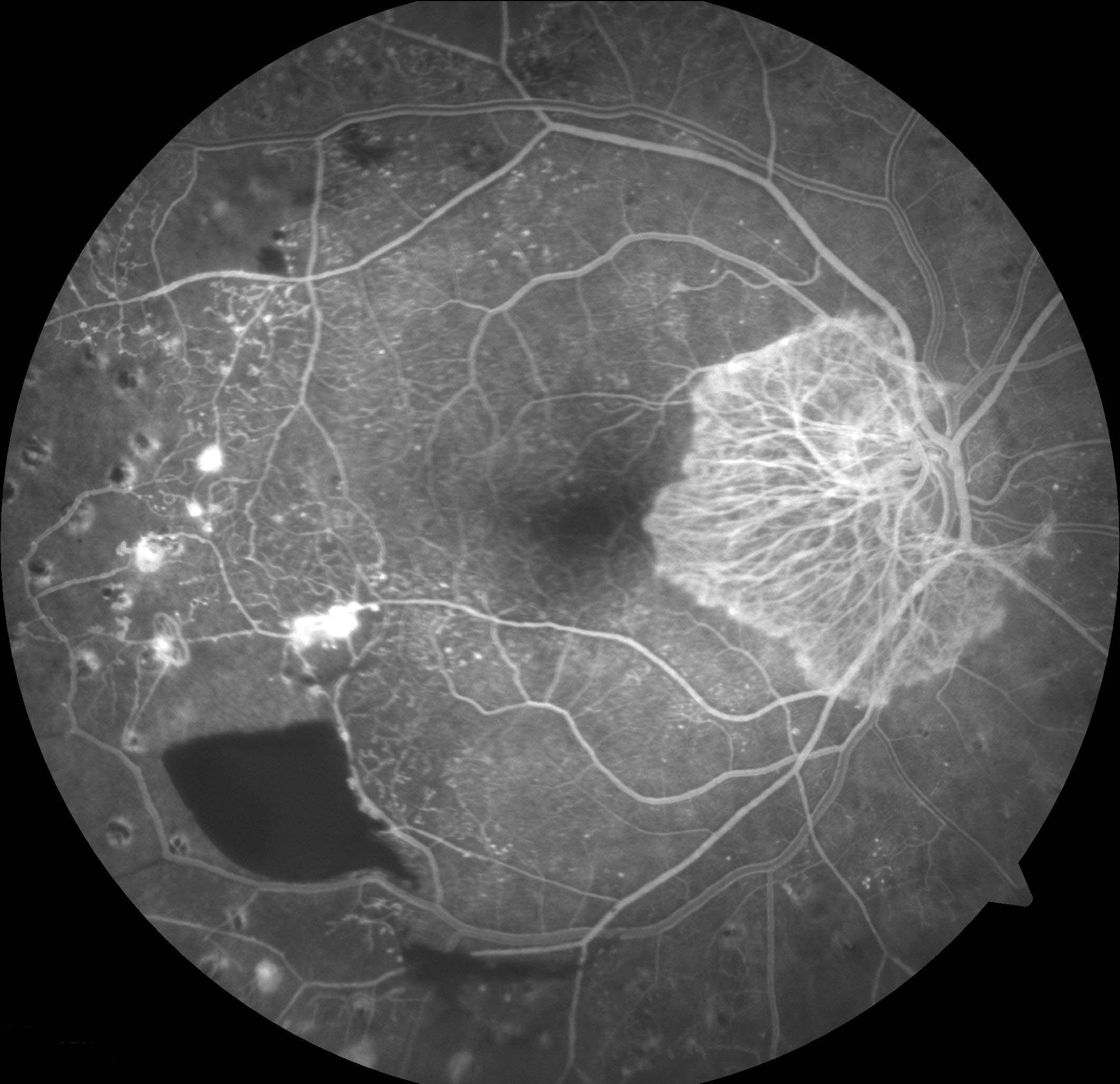 Figure 9.8.13 Neovascularisation of the Optic Disc (NVD)