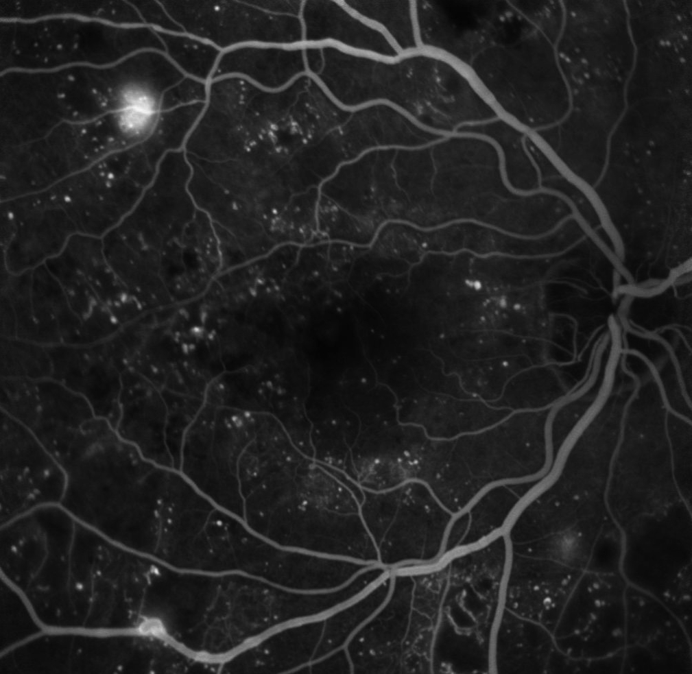 Figure 9.8.14 Proliferative Diabetic Retinopathy