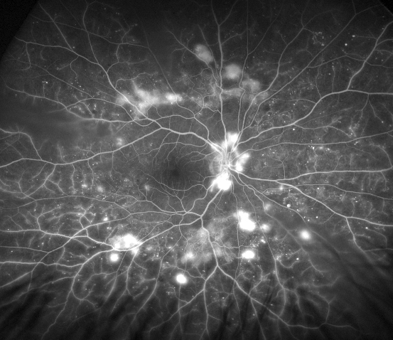 Figure 9.8.15 Proliferative Diabetic Retinopathy (Optos®)