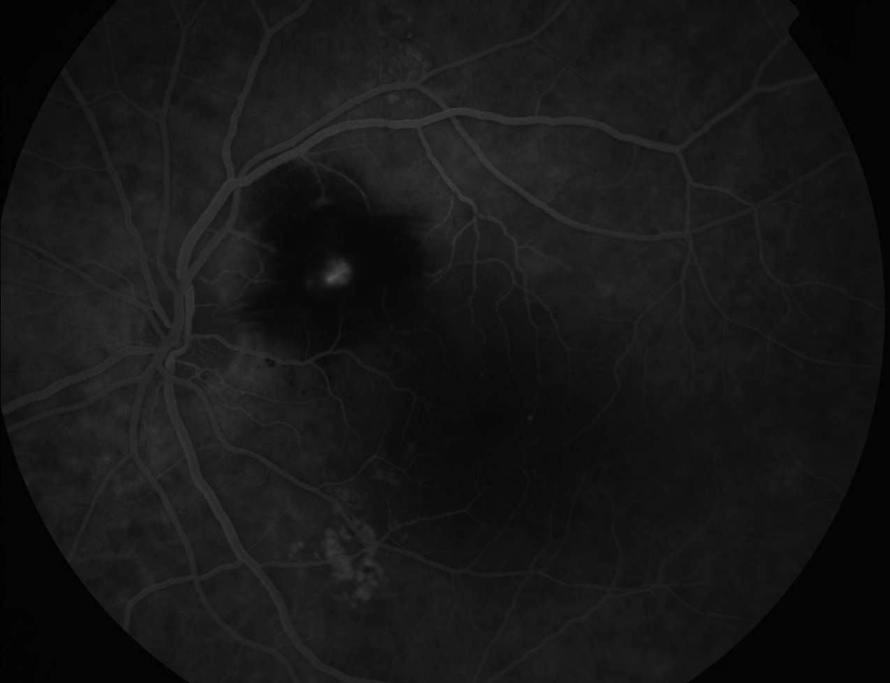 Figure 9.8.16 Retinal Macroaneurysm