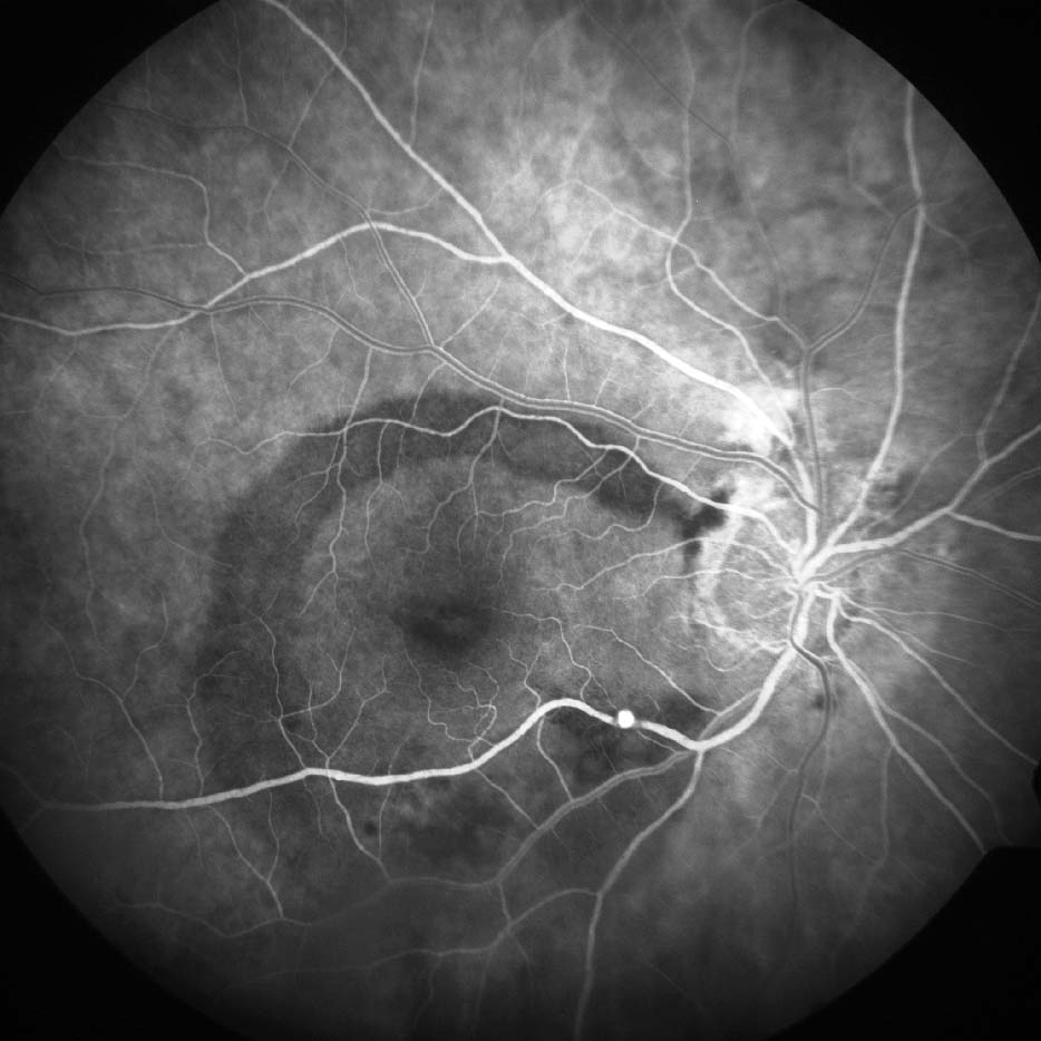 Figure 9.8.17 Retinal Arteriolar Macroaneurysm