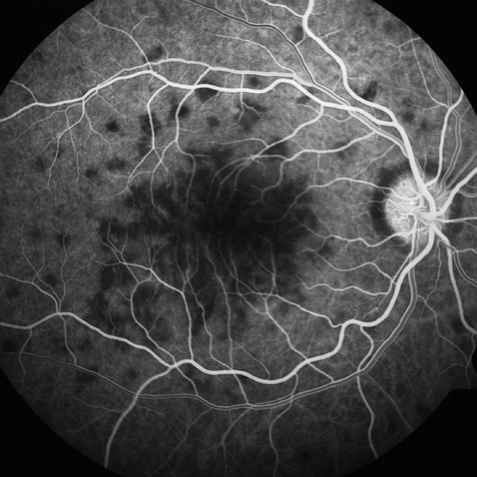 Figure 9.8.2 Acute Posterior Multifocal Placoid Pigment Epitheliopathy (APMPPE)