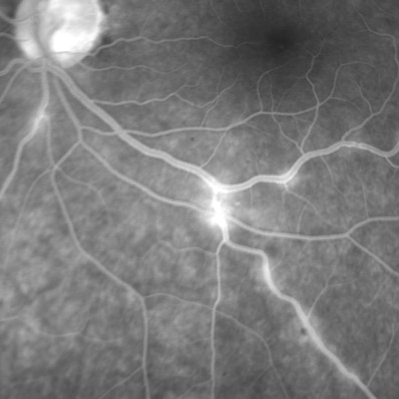 Fundus Angiography - Fluorescein | 9.8 | Westmead Eye Manual