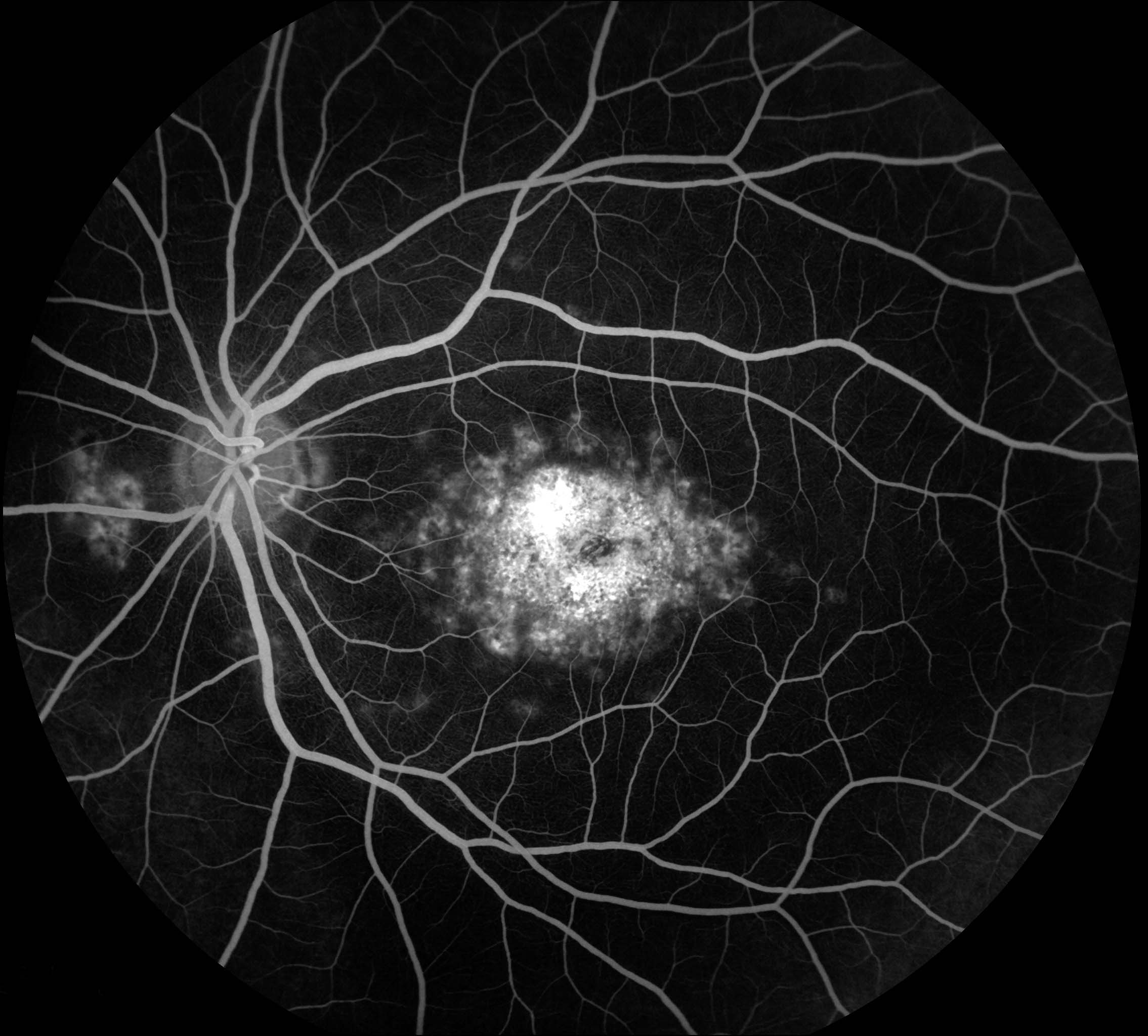 Fundus Angiography - Fluorescein | 9.8 | Westmead Eye Manual
