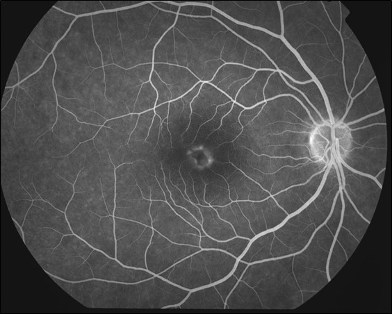 Figure 9.8.3 Adult Vitelliform Macular Degeneration