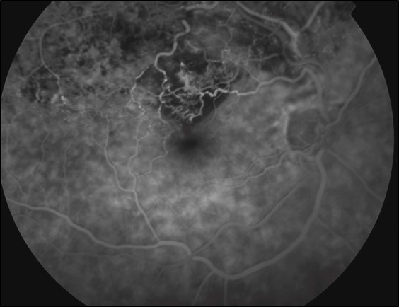 Figure 9.8.4 Branch Retinal Vein Occlusion 