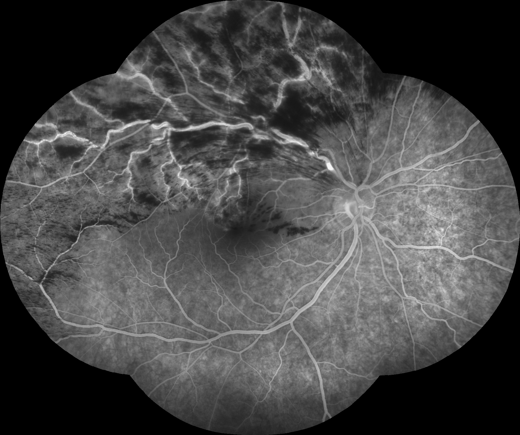 Figure 9.8.5 Branch Retinal Vein Occlusion