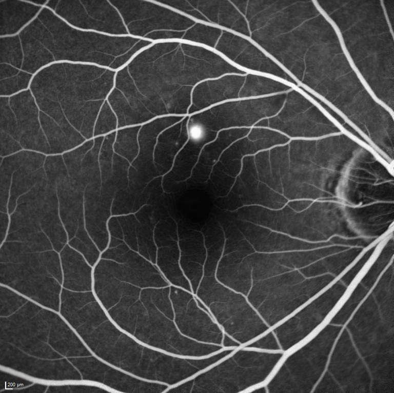 Figure 9.8.6 Central Serous Chorioretinopathy