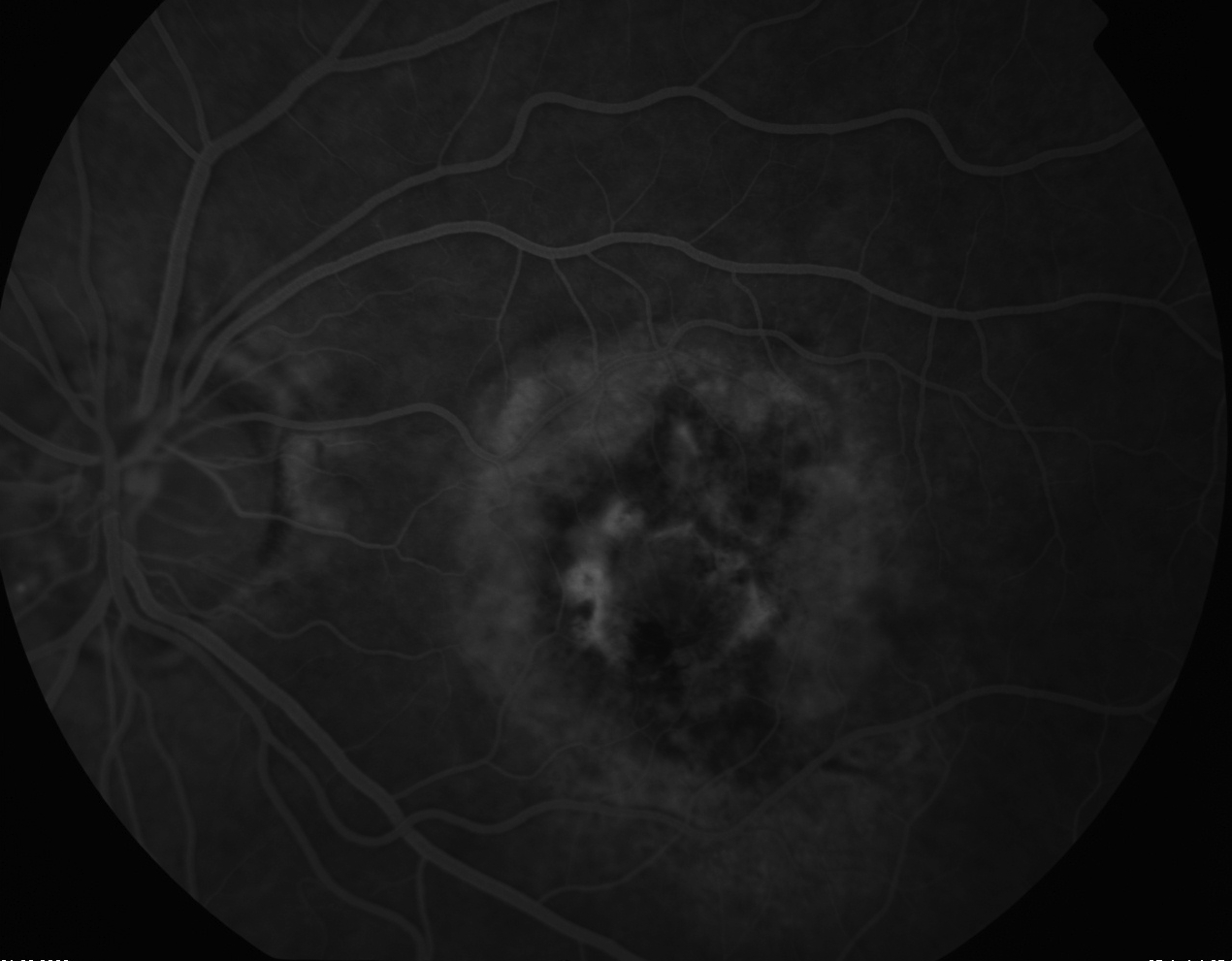 Figure 9.8.7 (Classic Subfoveal) Choroidal New Vessel