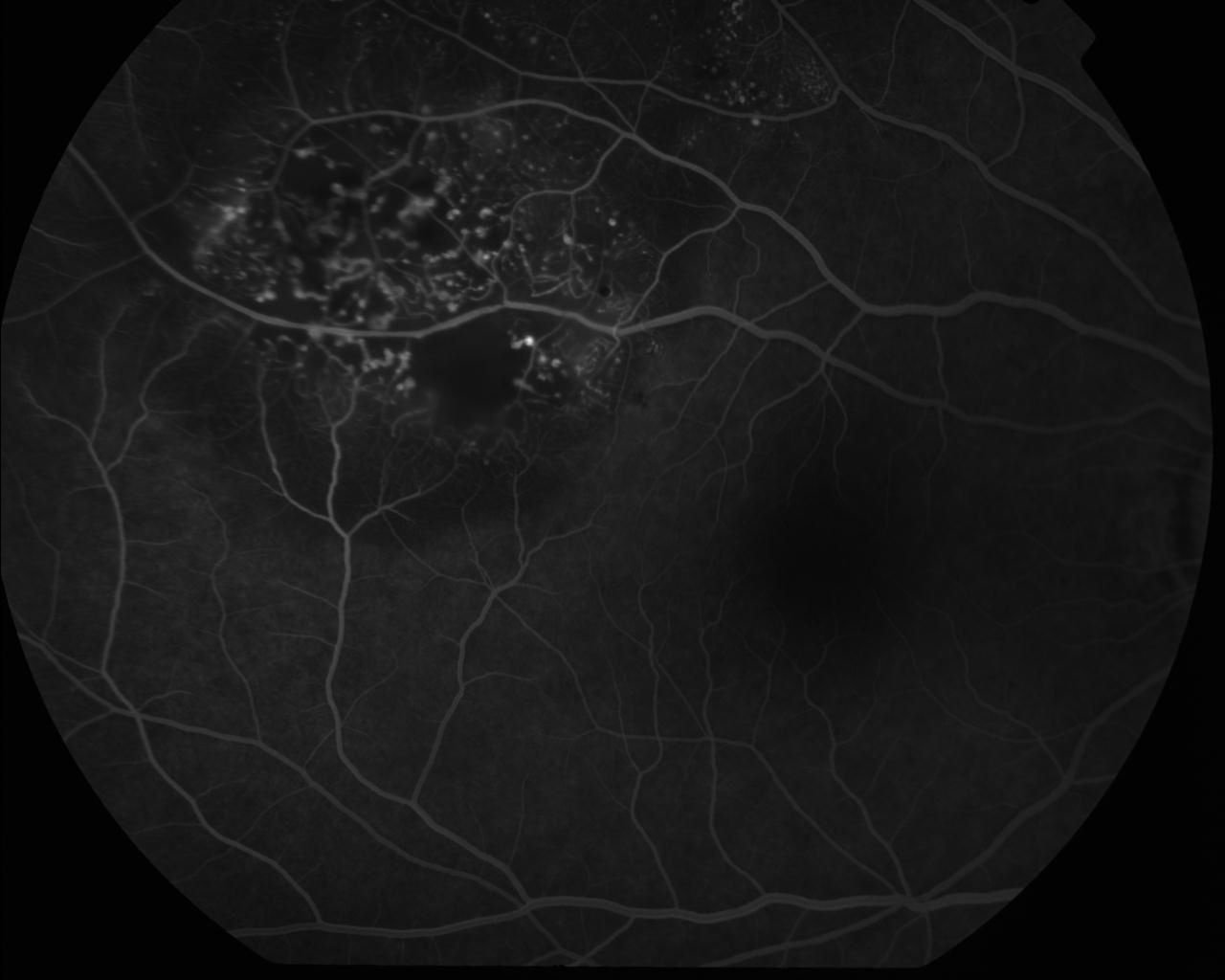 Figure 9.8.8 Coats Disease