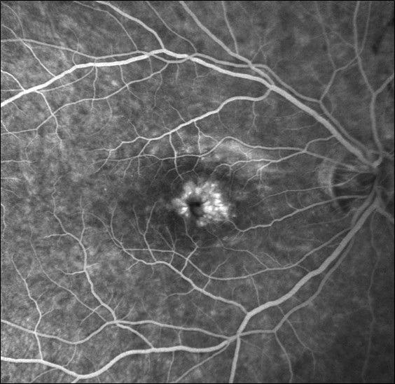 Figure 9.8.9 Cystoid Macular Oedema