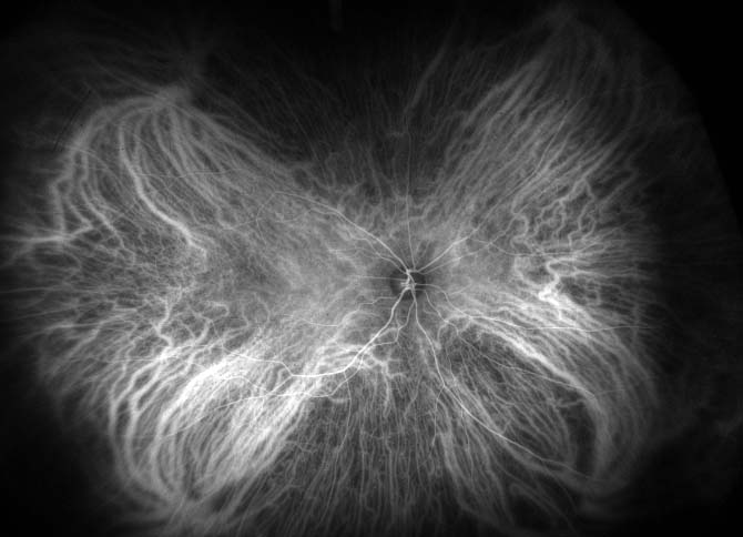 Figure 9.9.1 Normal ICG Angiogram 1 Minute 15 Seconds Post Injection (Early Mid-Phase)