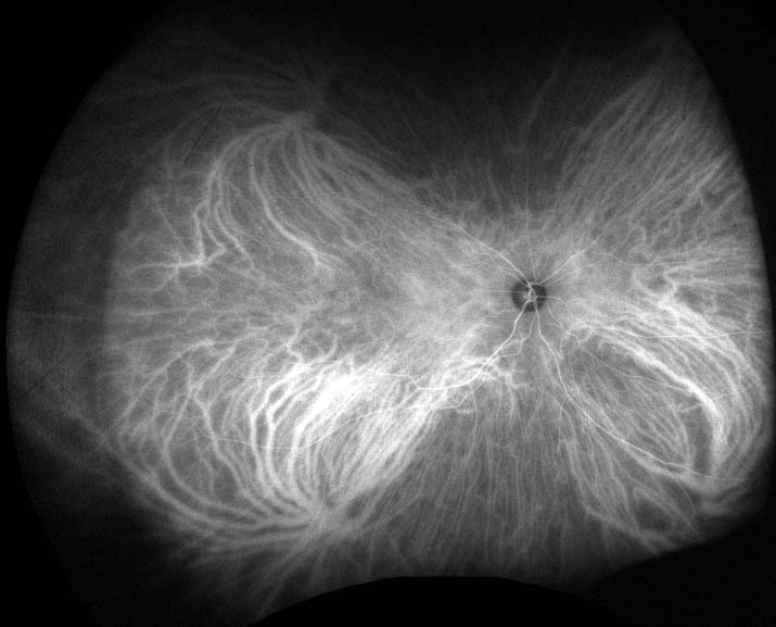 Figure 9.9.2 Normal ICG Angiogram 5 Minutes Post Injection (Late Mid-Phase)