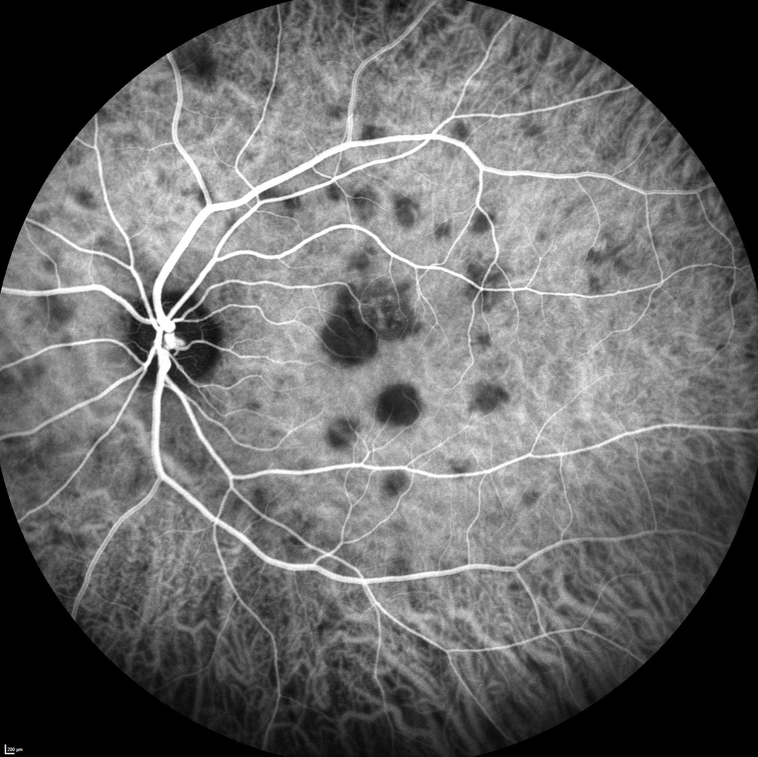 Figure 9.9.3 Acute Posterior Multifocal Placoid Pigment Epitheliopathy (APMPPE)