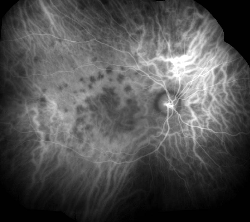 Figure 9.9.4 Acute Posterior Multifocal Placoid Pigment Epitheliopathy (APMPPE) (Late Phase)