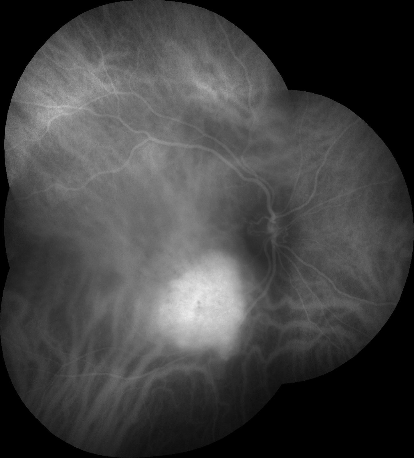 Figure 9.9.5 Choroidal Haemangioma