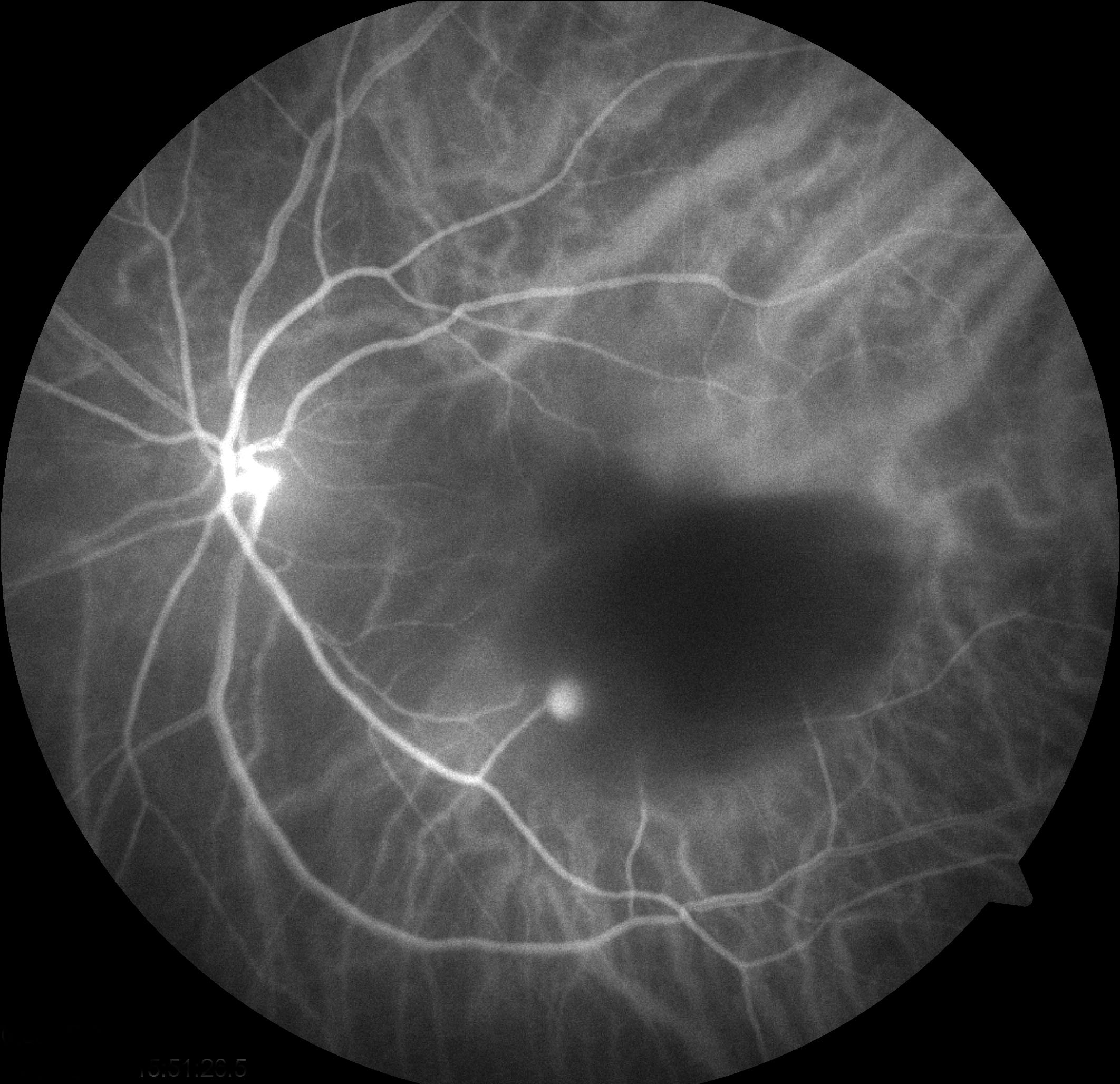 Figure 9.9.7 Ruptured Macroaneurysm
The hyperfluorescent spot represents a macroaneurysm with an adjacent area of retinal haemorrhage.